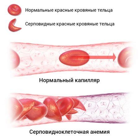 як лікувати гемолітична анемія