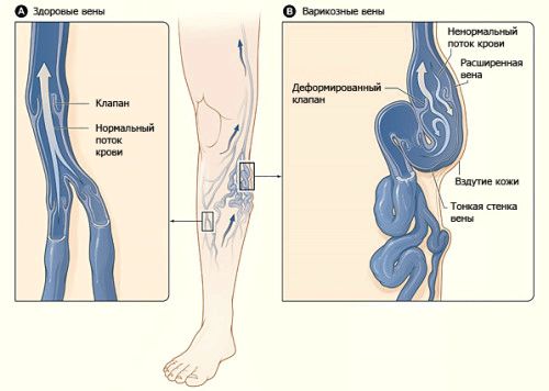 вилікувати варикоз вен
