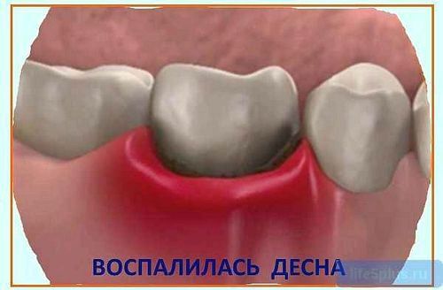 Лікування гінгівіту: що робити коли запалена ясна зуб