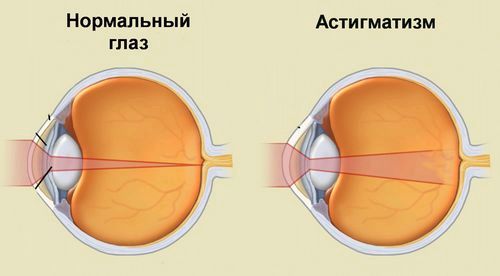 як лікувати астигматизм будинку