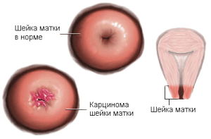 як лікувати рак шийки матки 2 стадії