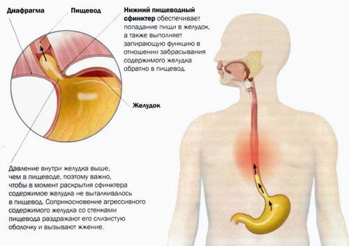 як лікувати печіння в шлунку