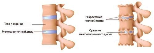 як лікувати хондроз попереку