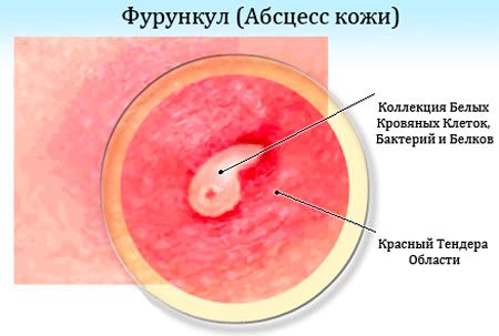 ефективна мазь Левомеколь при фурункулах