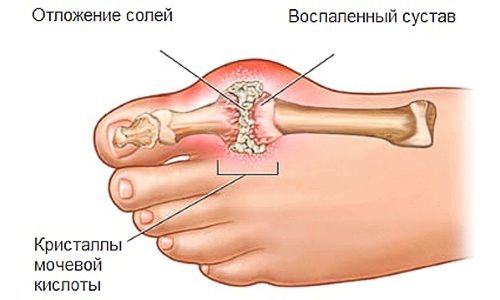 лікувати суглоби пальців ніг