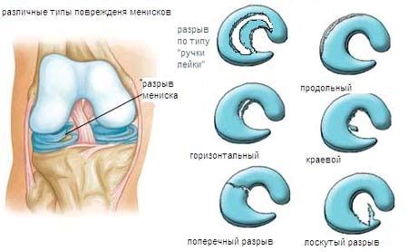 як лікувати внутрішній меніск