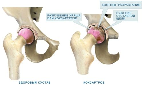 як вилікувати артроз тазостегнового суглоба