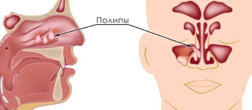 Cінусіт - рентгенівський знімок хронічний гайморит на рентгені