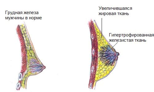 як лікувати мастопатію у чоловіків