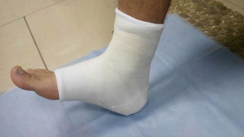 Розтягнення зв'язок гомілковостопного суглоба розтягнення зв'язок гомілкостопу лікування