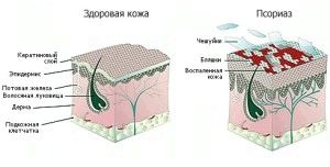 як лікувати псоріаз на ранній стадії