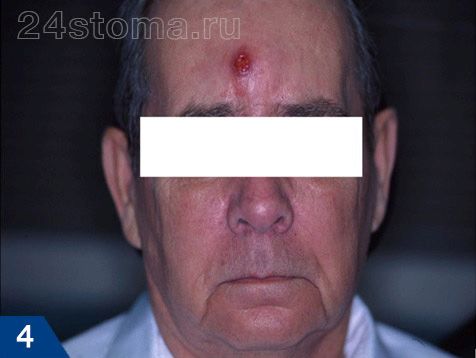 Фронтит - симптоми і лікування в домашніх умовах фронтит симптоми лікування