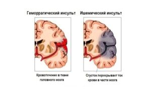 Інсульт правого боку головного мозку: наслідки і паралізація як лікувати інсульт права півкуля головного мозку