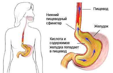 ніж лікувати печію у дітей