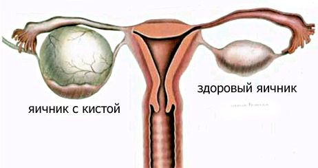 Лікування кісти яєчника в домашніх умовах народними засобами без операції як лікувати кісту без операції