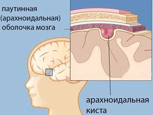 як лікувати кісту в голові у новонародженого