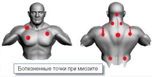 як лікувати міозит м'язів спини