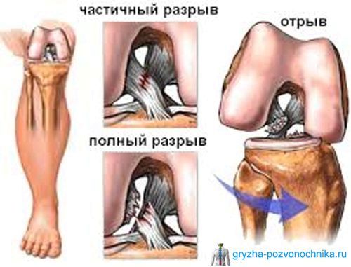 частковий розрив зв'язок