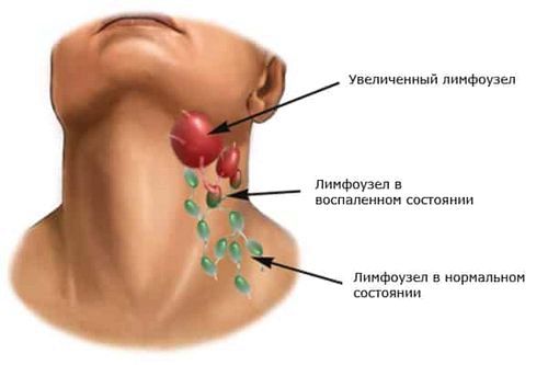 як лікувати лімфовузли на шиї будинку