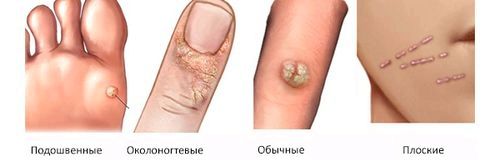 Діагностика і лікування папілом у вашої дитини папіломи у дітей лікування