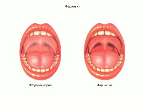 як лікувати грип удома