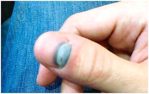 Як вилікувати забій нігтя на руці як вилікувати забій нігтя
