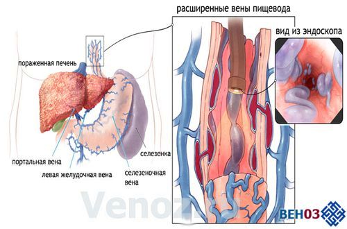варикозне розширення вен стравоходу цирозі печінки варикоз ранніх стадіях народними засобами ступеня