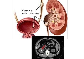 виведення каменів із сечоводу народними засобами