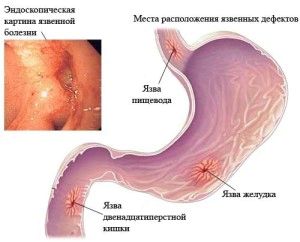 болить шлунок алкоголь робити підшлункова залоза запустити п'янка виразка можна відновити коліт голодний пиво розлад вплив ФГС тяжкість вино