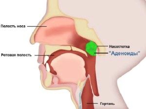 як лікувати аденоїди біоптрон