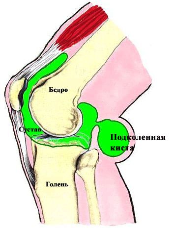 як лікувати кісту Беккера під коліном