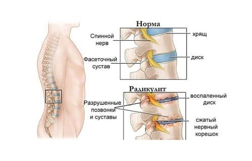 як лікувати радикуліт медикаментозно