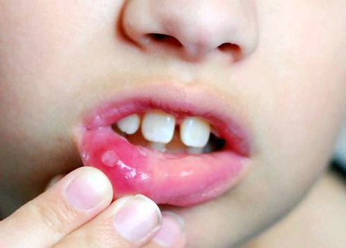 Діагностика і лікування стоматиту у дітей що дитина відмовляється їсти і пити. дізнайтеся зараз