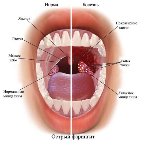 Як лікувати фарингіт: симптоми і види захворювання фарингіт симптоми лікування як лікувати фарингіту у дорослих в домашніх умовах хронічний гострий і ліками ознаки алергічний атрофічний фото горла захворювання вірусний причини гнійний форум ніж хвороба температура при фарингіті призначають виглядає
