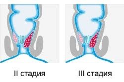 вилікувати геморой самостійно