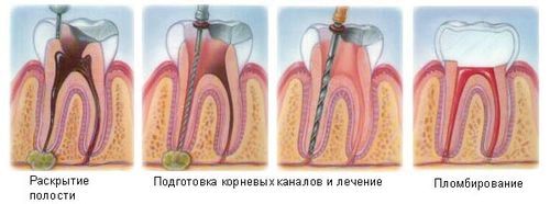 Кіста в зубі кіста