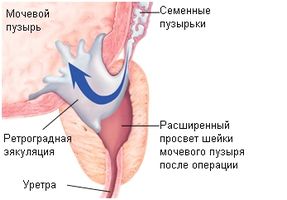 Хто ще хоче спробувати лікування простати содою? як лікувати тиск содою