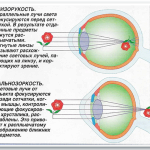 як лікувати короткозорість очей