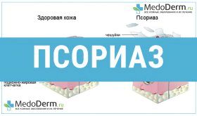 як вилікувати псоріаз на руці