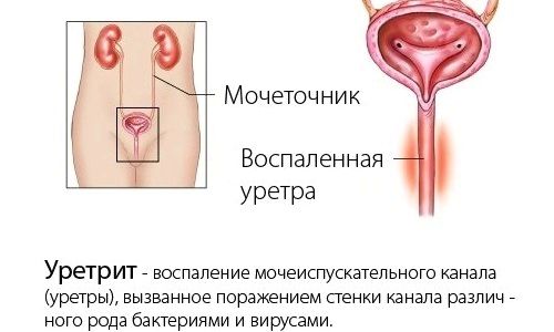 чи можна вилікувати уретрит без антибіотиків