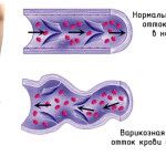 як лікувати варикоз на руках