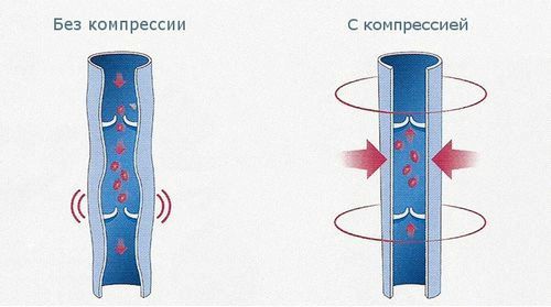 як лікувати варикоз у жінок