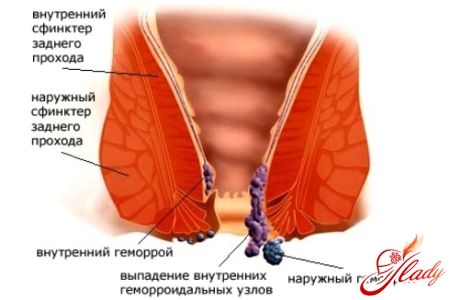 Болі при геморої у жінок як вилікувати геморой без болю