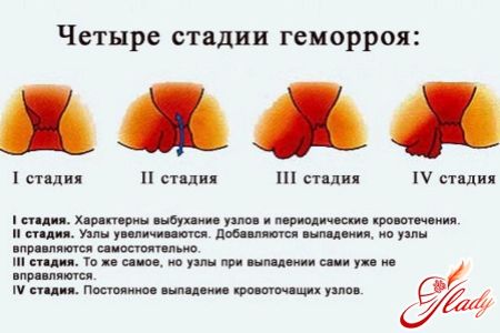 Болі при геморої у жінок як вилікувати геморой без болю