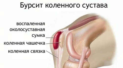 Бурсит колінного суглоба - причини, симптоми, лікування бурсит колінний суглоб коліно синовіальна сумка запалення бурса мастило причини симптоми лікування