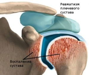 як лікувати ревматизм плеча