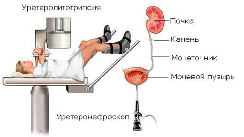 Що робити якщо камені в нирках? Як позбутися від напасті як лікувати нирки якщо є камені