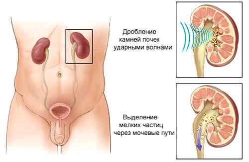 Що робити якщо камені в нирках? Як позбутися від напасті як лікувати нирки якщо є камені