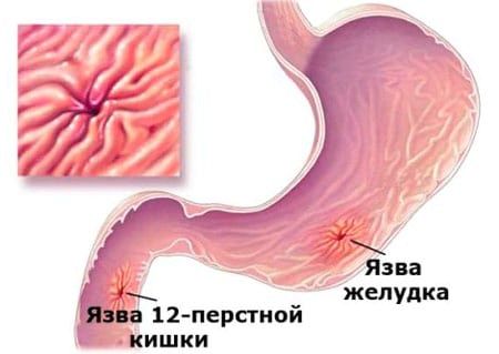 як лікувати виразку шлунка будинку