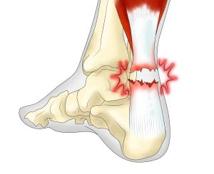 як лікувати бурсит ахіллового сухожилля